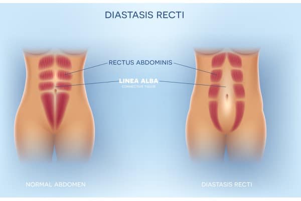 What Non-Surgical Options Are Available for Diastasis Recti Newlands?