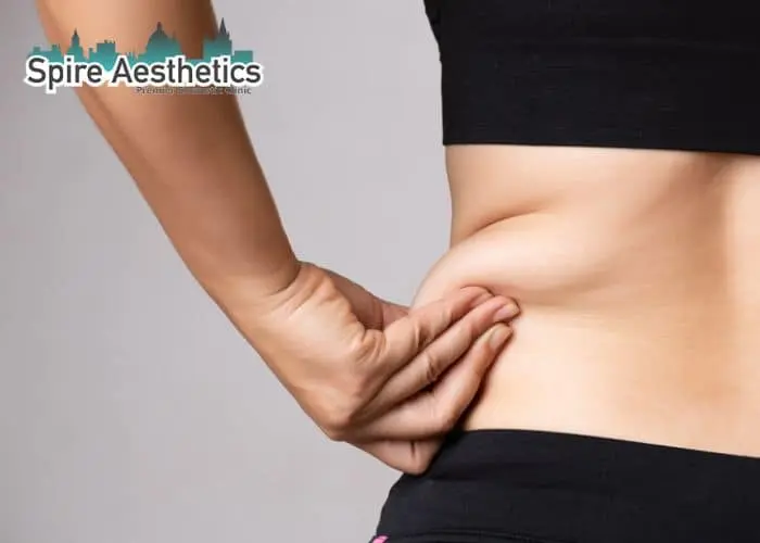 Image of woman pinching fat on their hips Newlands. Fat Freezing treatment