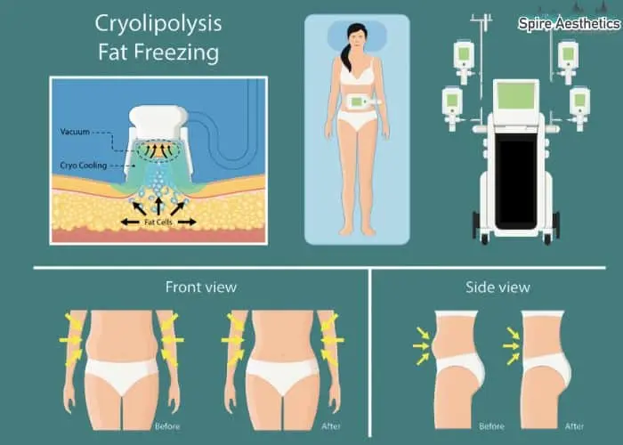 Fat freezing treatment Newlands benefits for competitions to remove stubborn fat deposits.